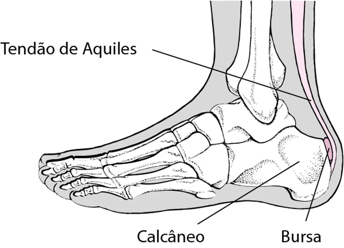 Bursite calcânea