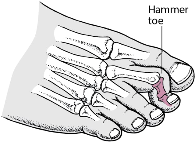 Lesser Toe Block Image:Hammer Toe-MSD Manual Professional Edition