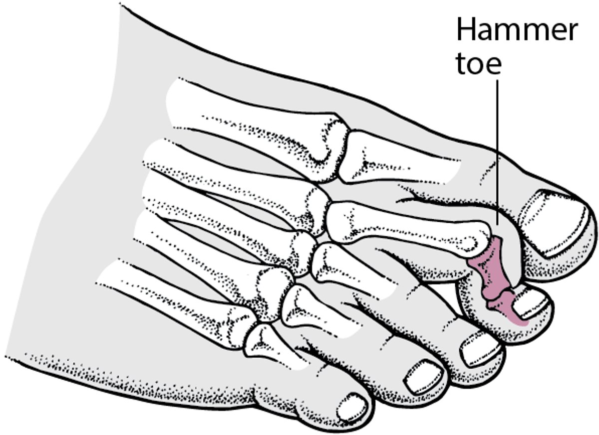 Hammer Toe