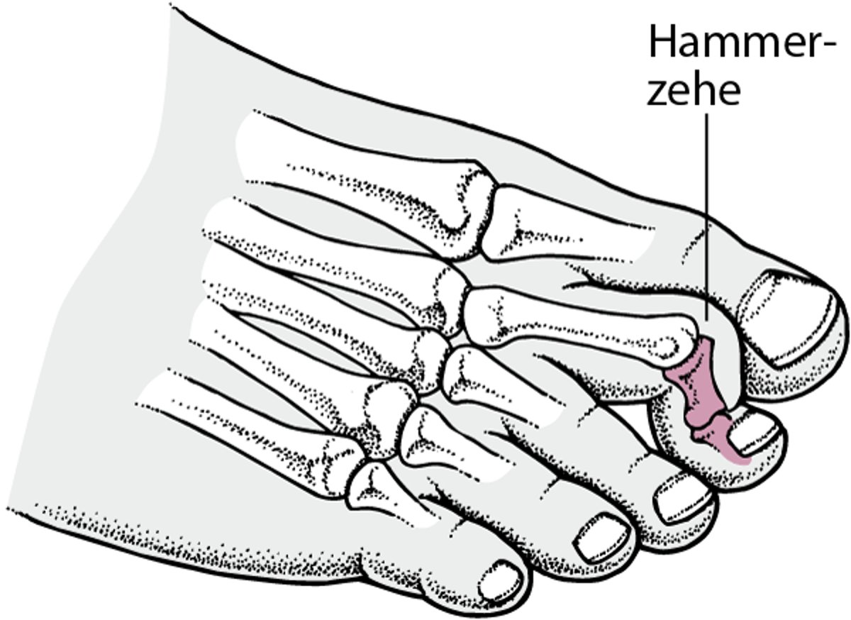 Hammerzehe