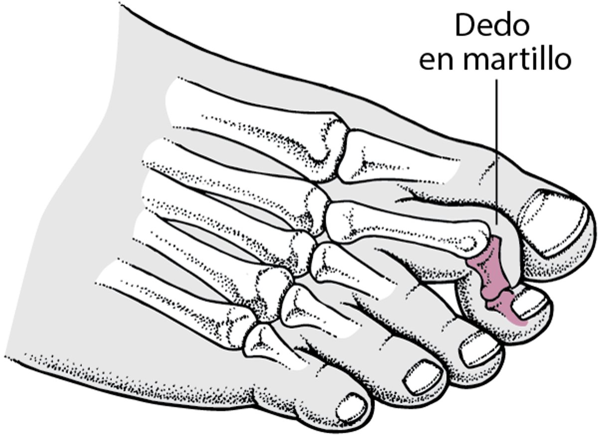 Dedo en martillo