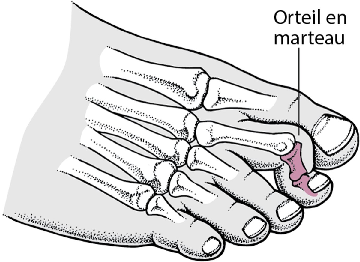 Orteil en marteau