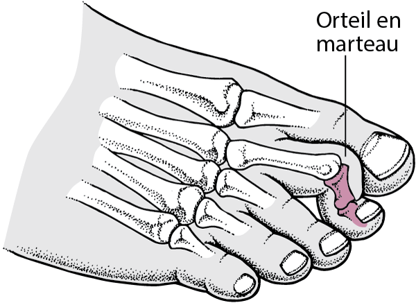 orteil en marteau avec épingle