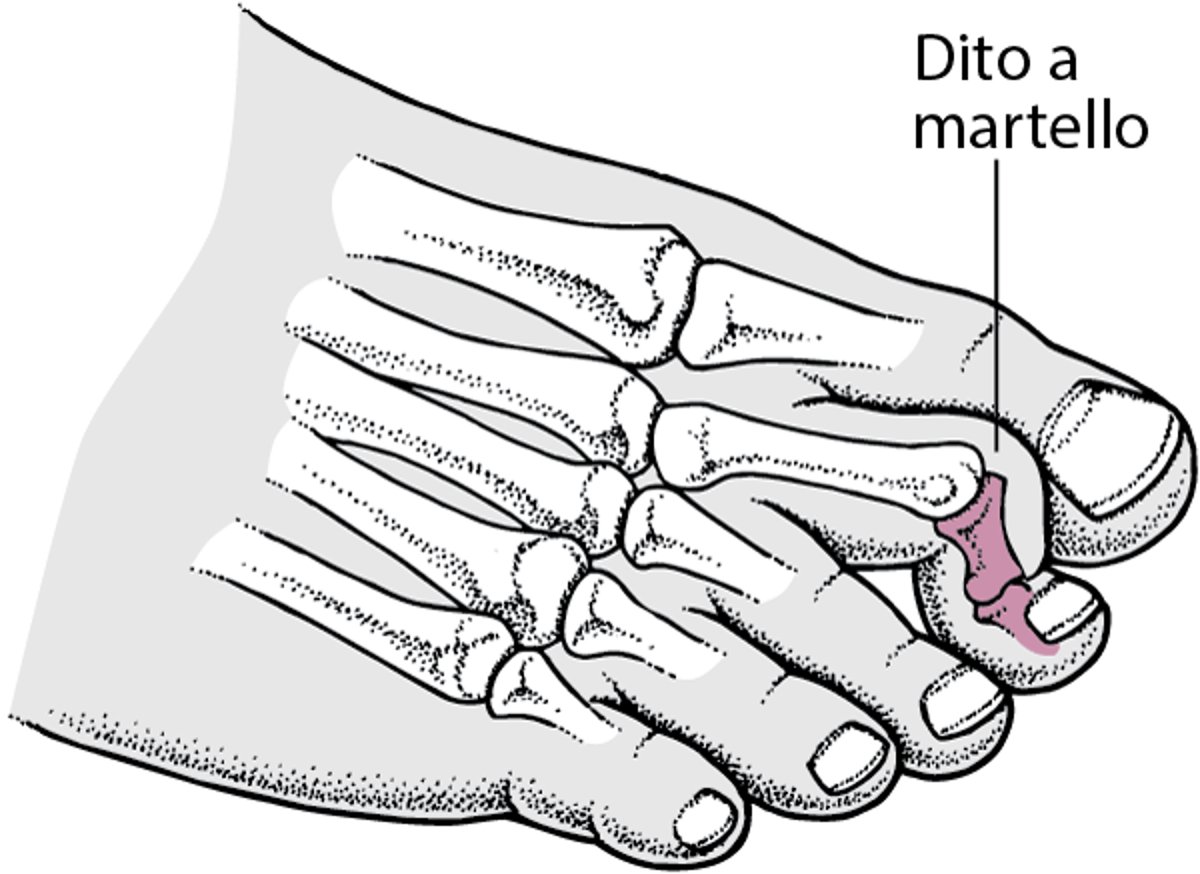 Dito a martello
