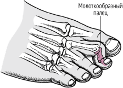 Молоткообразный палец стопы