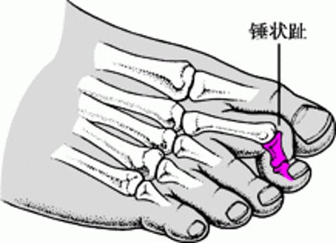 锤状趾