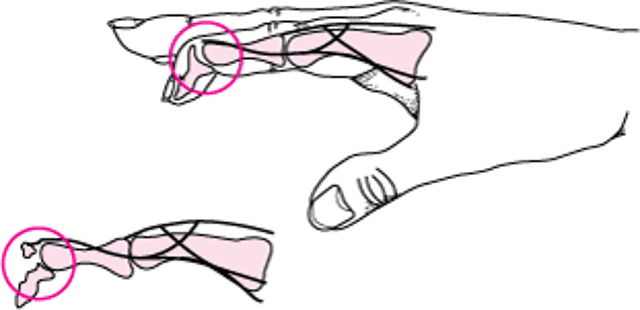 Молоткообразный палец