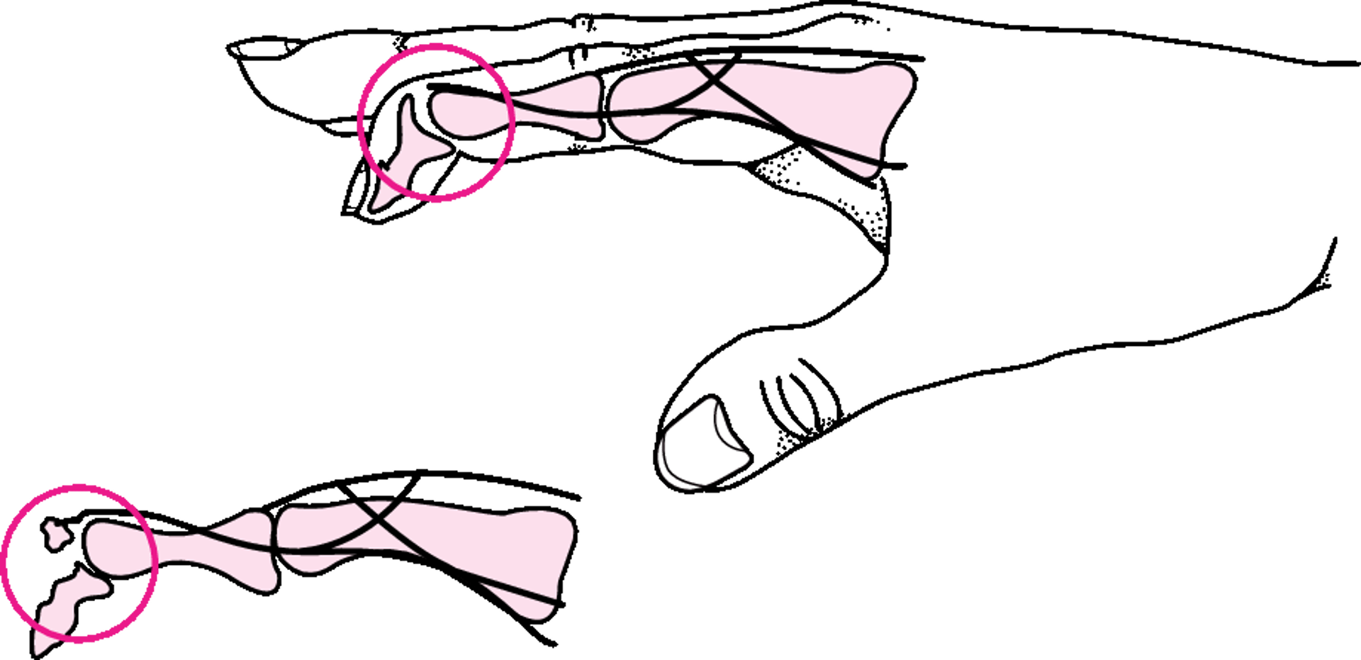 Đứt gân duỗi đốt xa ngón tay