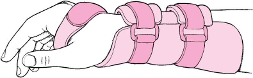 中立位での手関節の副子