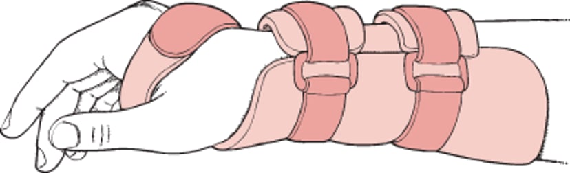 Nẹp cổ tay ở tư thế cơ năng