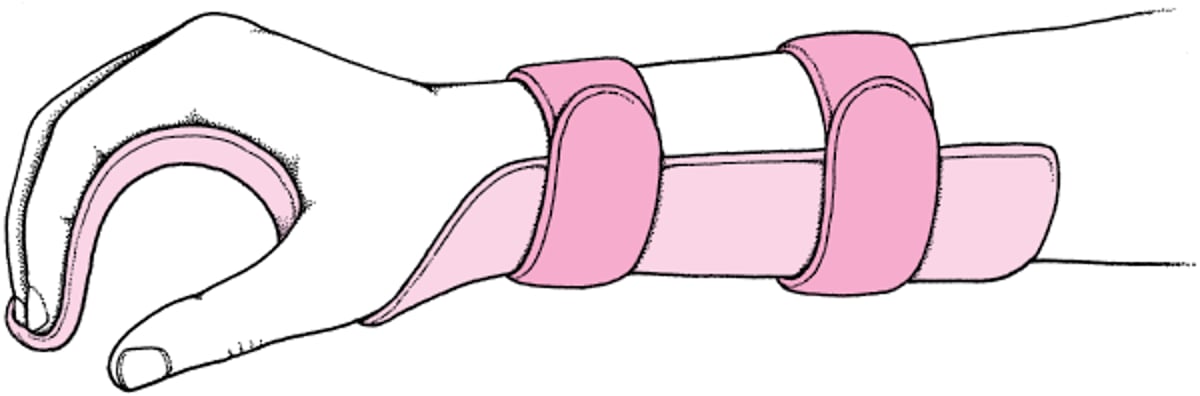 Férula en posición funcional (extensión de la muñeca en 20°, flexión de la articulación metacarpofalángica en 60°, leve flexión de la articulación interfalángica).