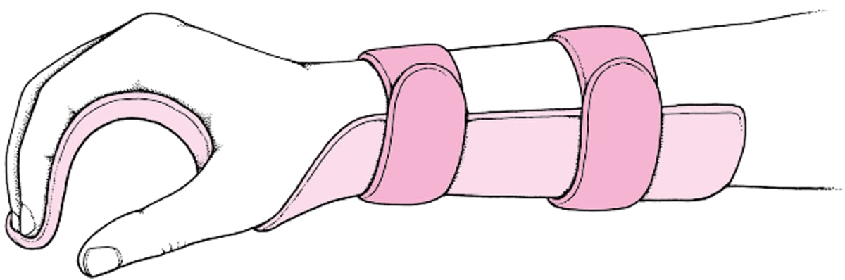 Tala em posição funcional (extensão do punho em 20 graus, flexão da articulação metacarpofalângica em 60 graus, discreta flexão interfalângica)