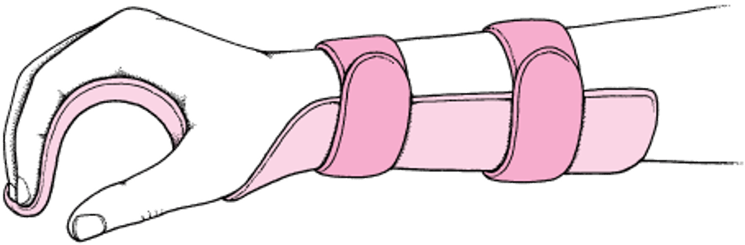 Иммобилизация в функциональном положении (разгибание лучезапястного сустава до 20 градусов, сгибание пястно-фаланговых суставов до 60 градусов, небольшое сгибание межфаланговых суставов)