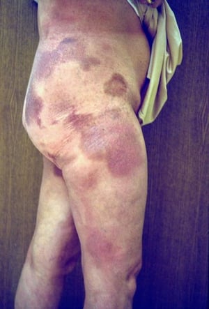 Mycosis fongoïde (tronc et jambe)