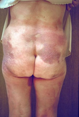 Mycosis fongoïde (fesses)