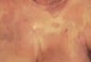 Micosis fungoide (tórax)