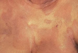 Mycosis fongoïde (thorax)