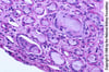 Myelomniere