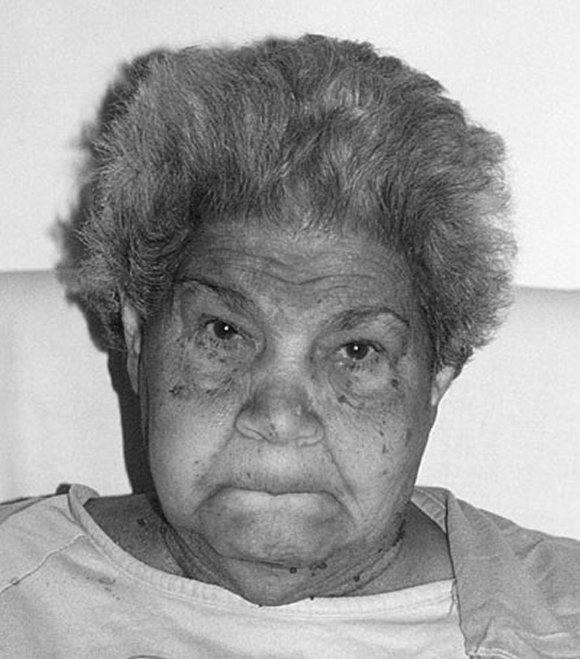 Myxedema in Hypothyroidism