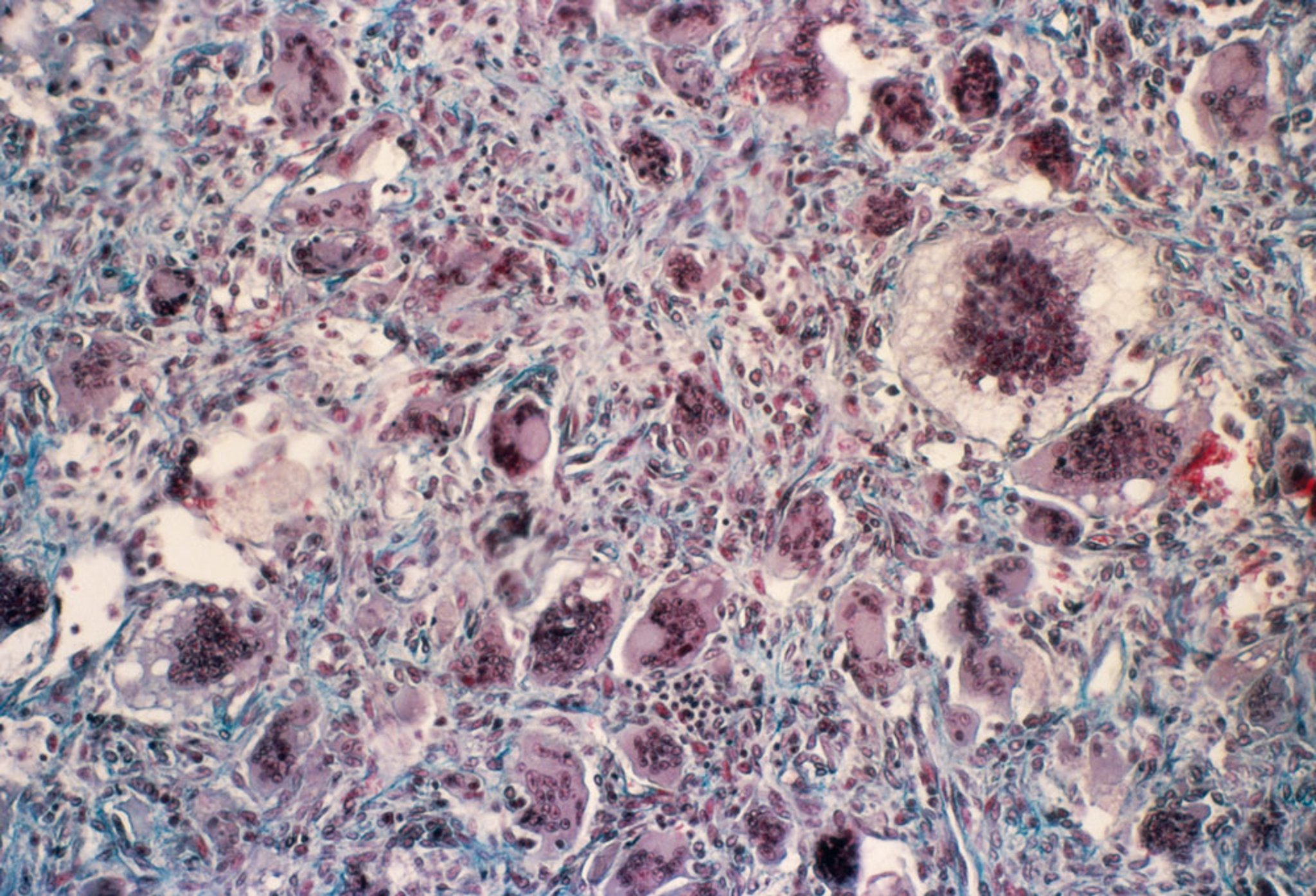 Osteitis Fibrosa Cystica (Brown Tumor)