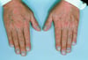 Digital Cyanosis and Clubbing