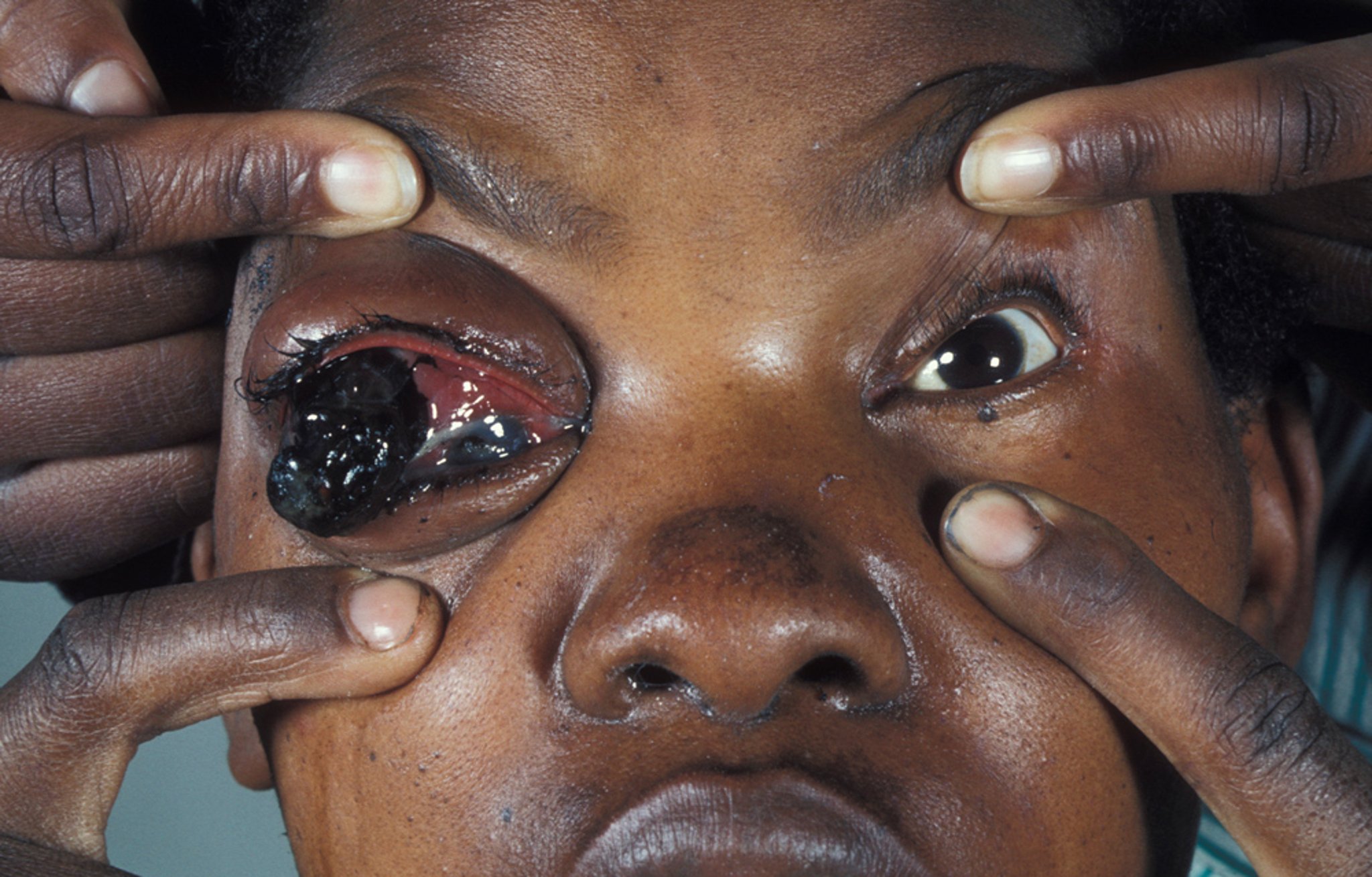 Melanoma del ojo