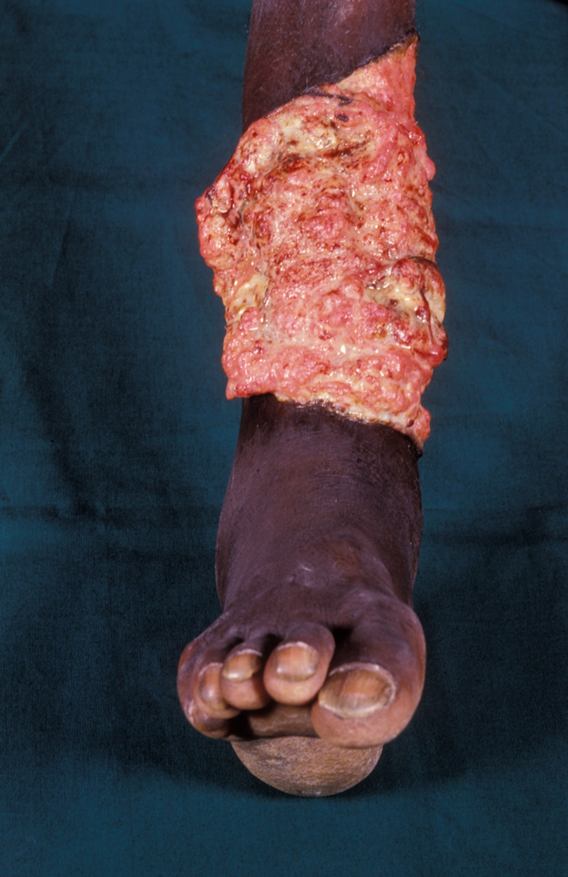 Carcinome malpighien avancé (2)