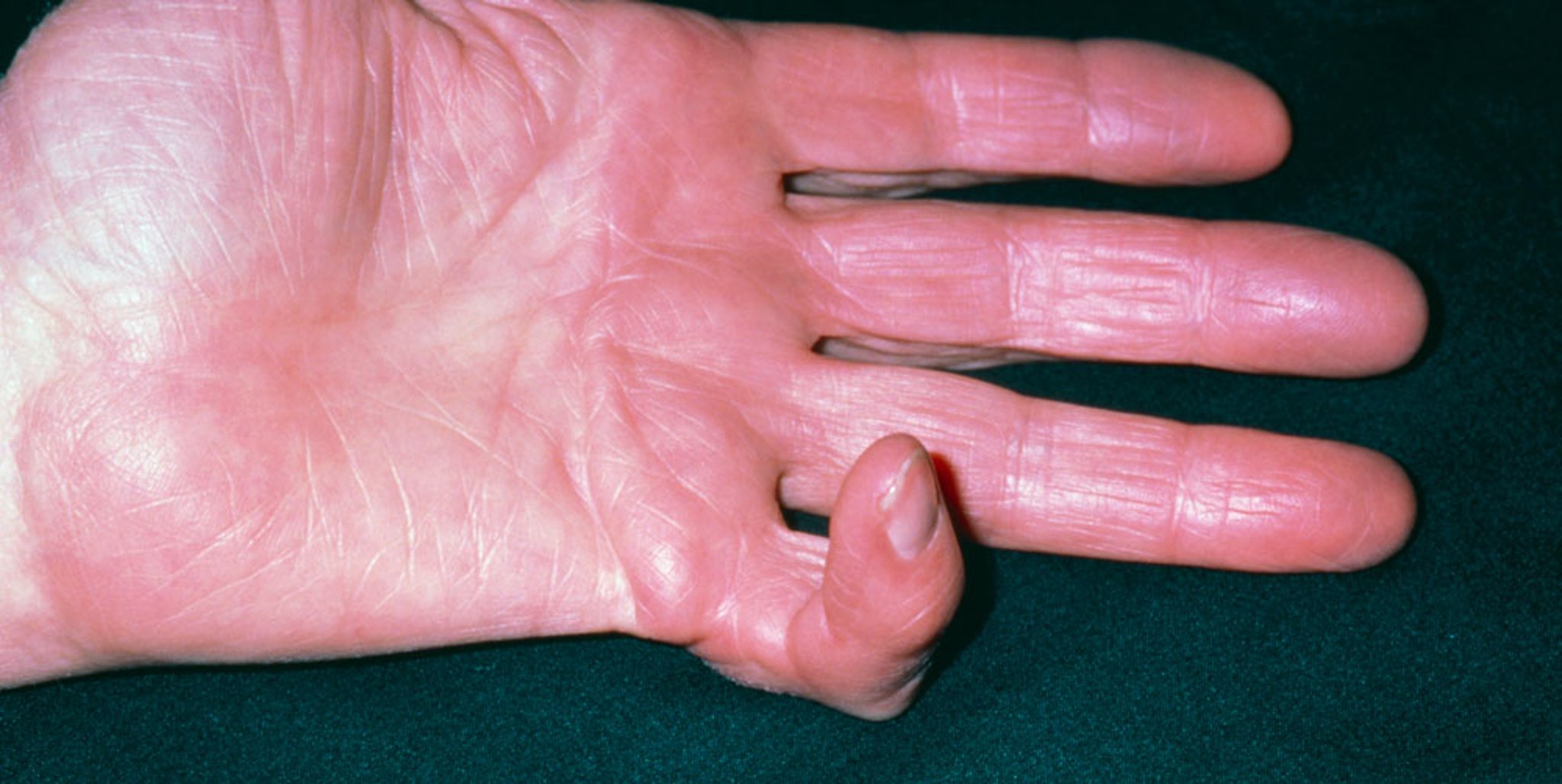 Dupuytren Contracture of the Little Finger