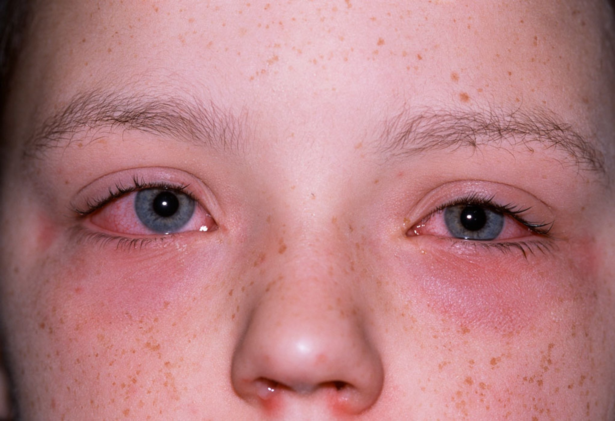 Allergic Conjunctivitis