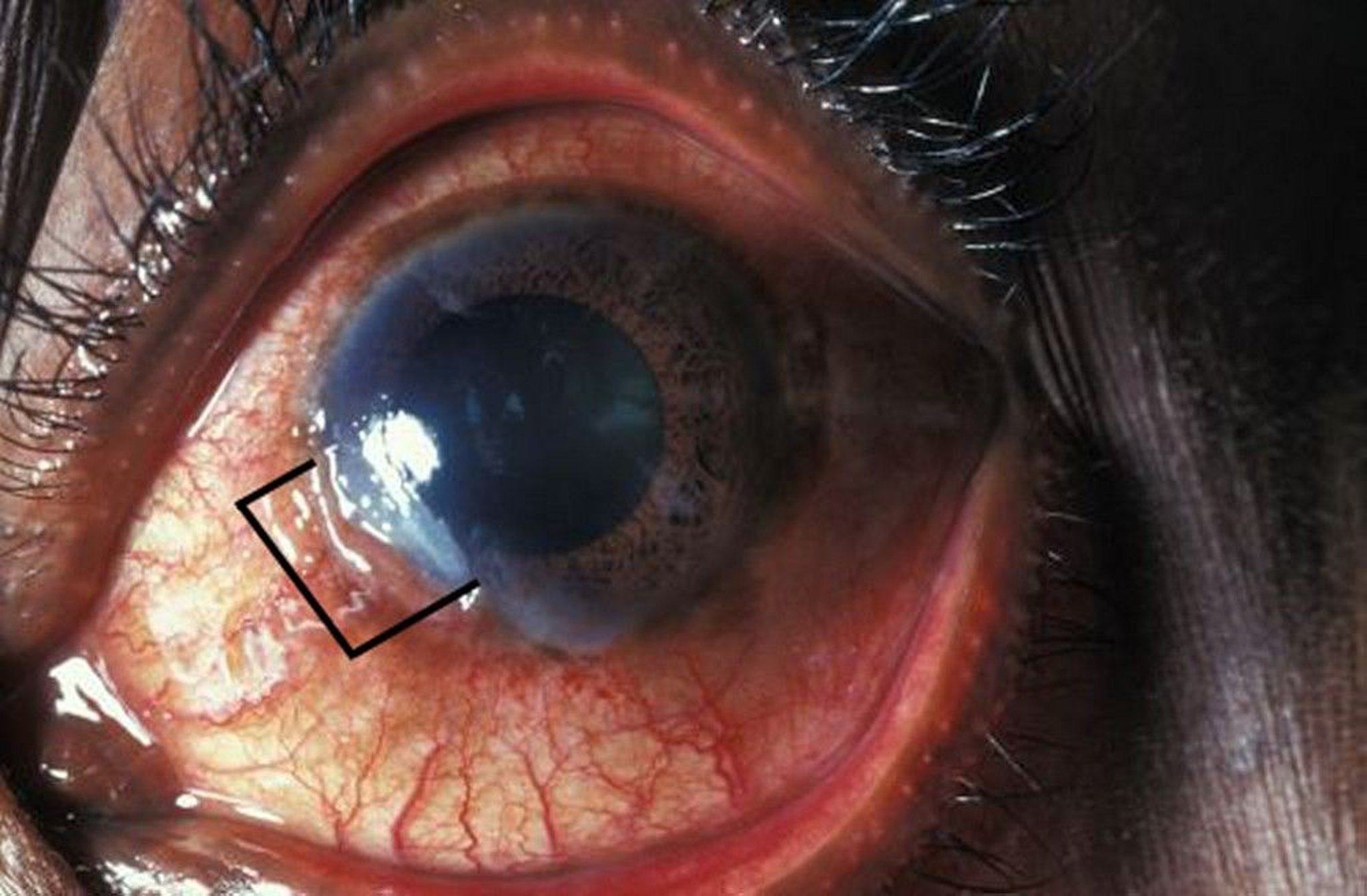 Keratitis (periphere Ulzeration)