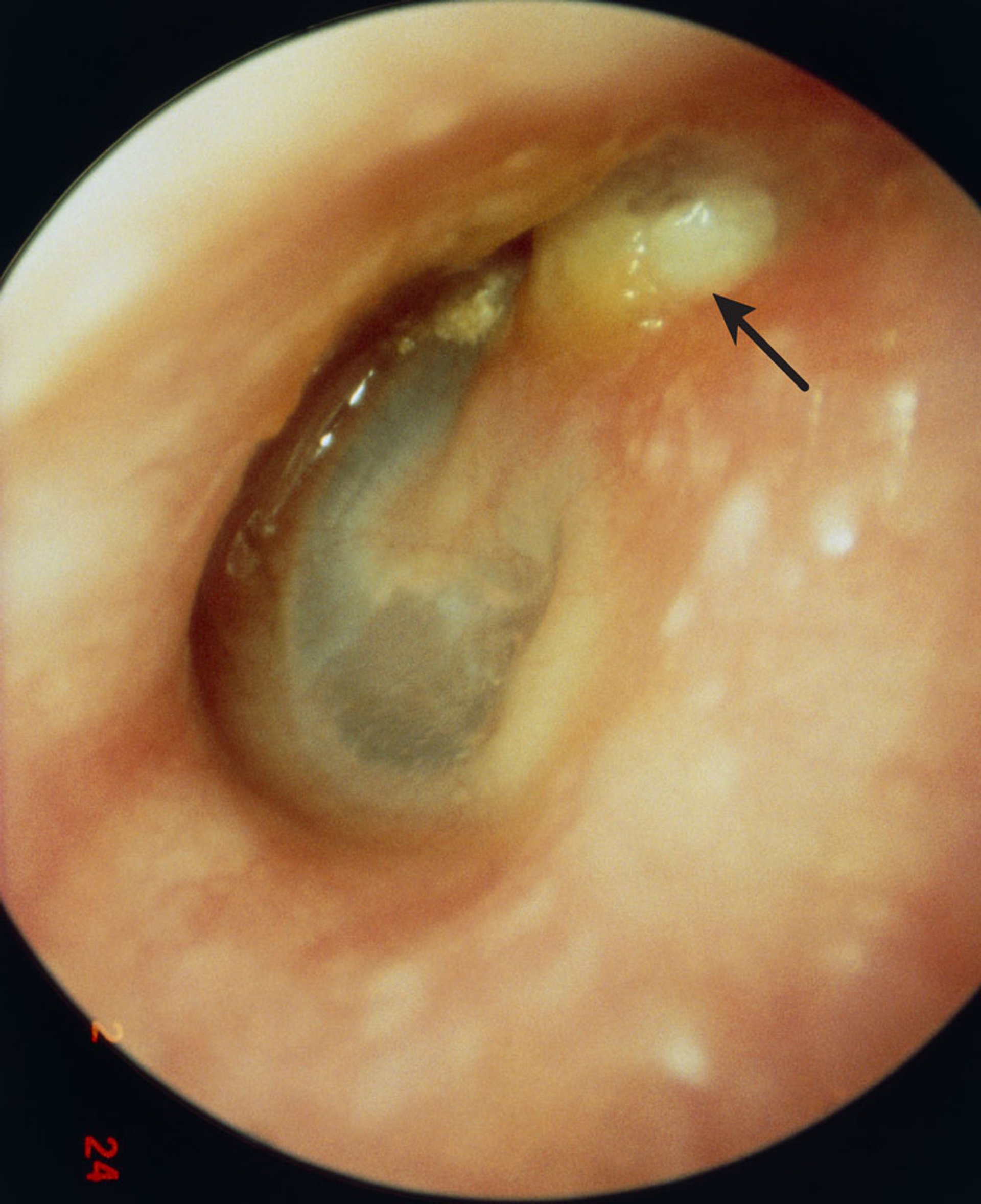 Cholesteatoma