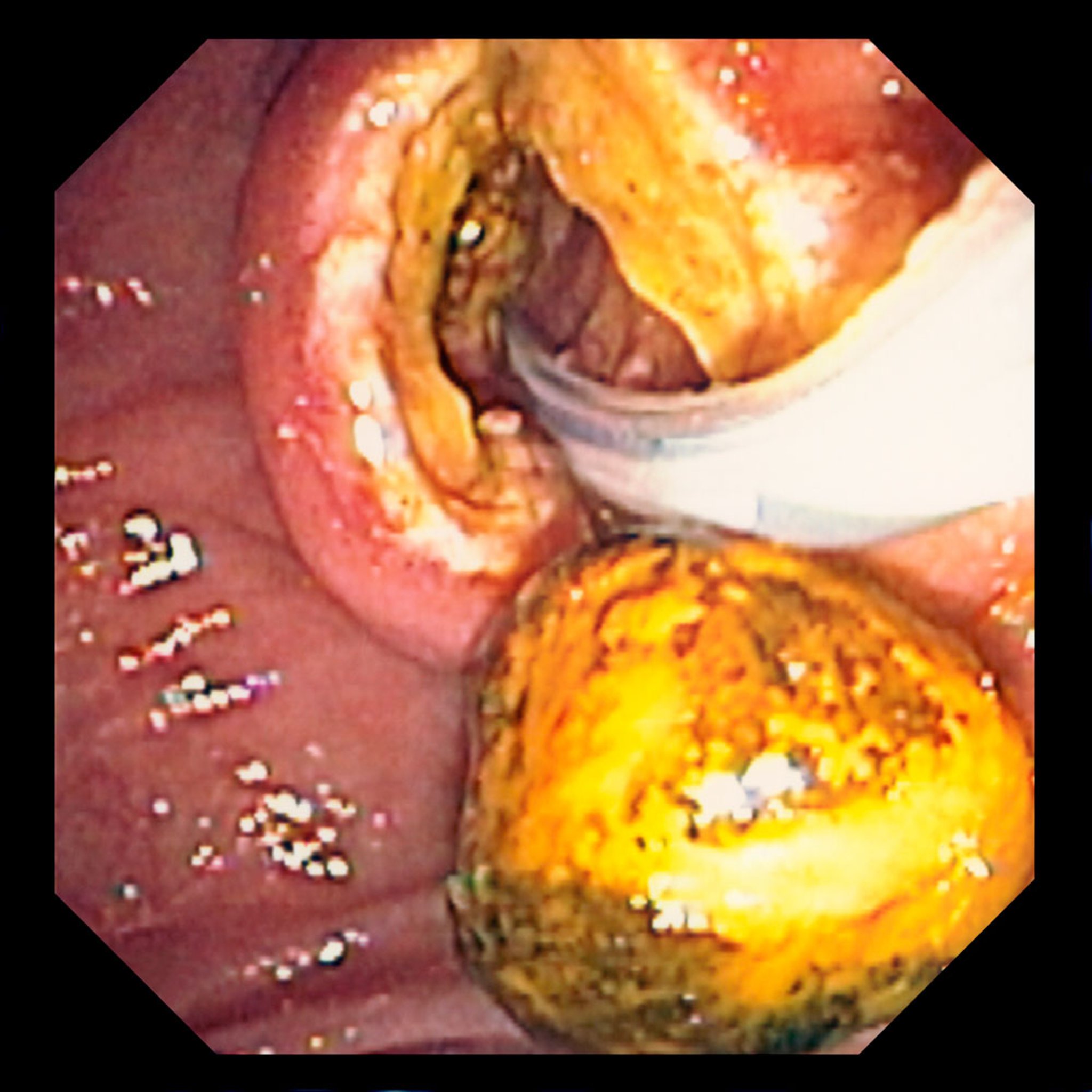 内窥镜逆行胰胆管造影 (ERCP) 伴括约肌切开术