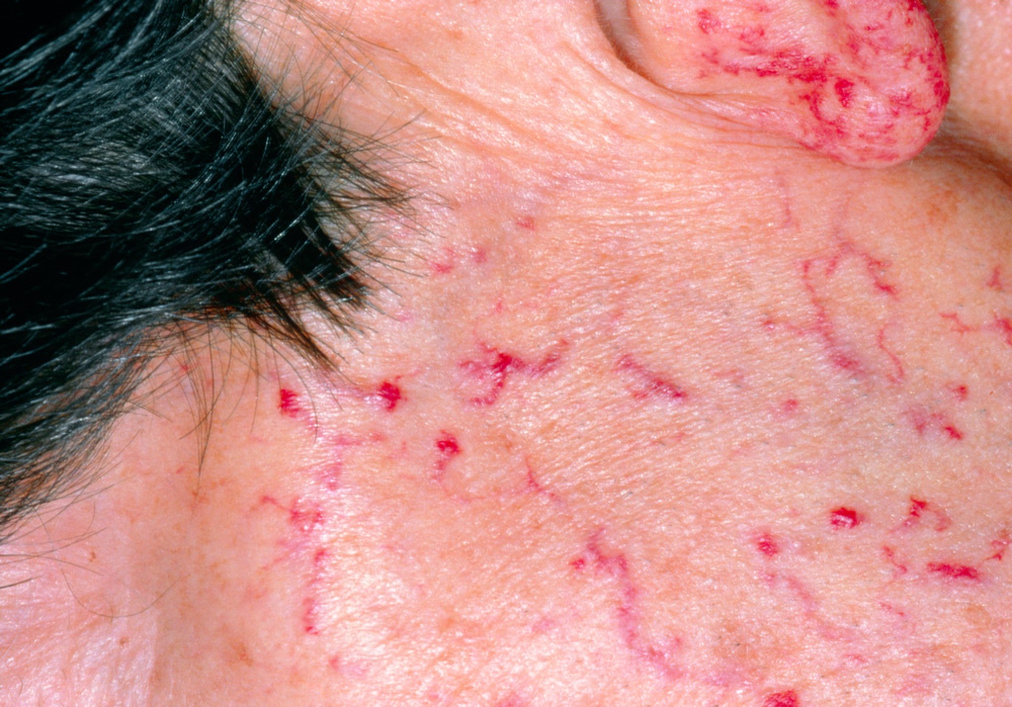 Hereditary Hemorrhagic Telangiectasia (Osler-Weber-Rendu Syndrome)