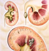 Urinary Calculi