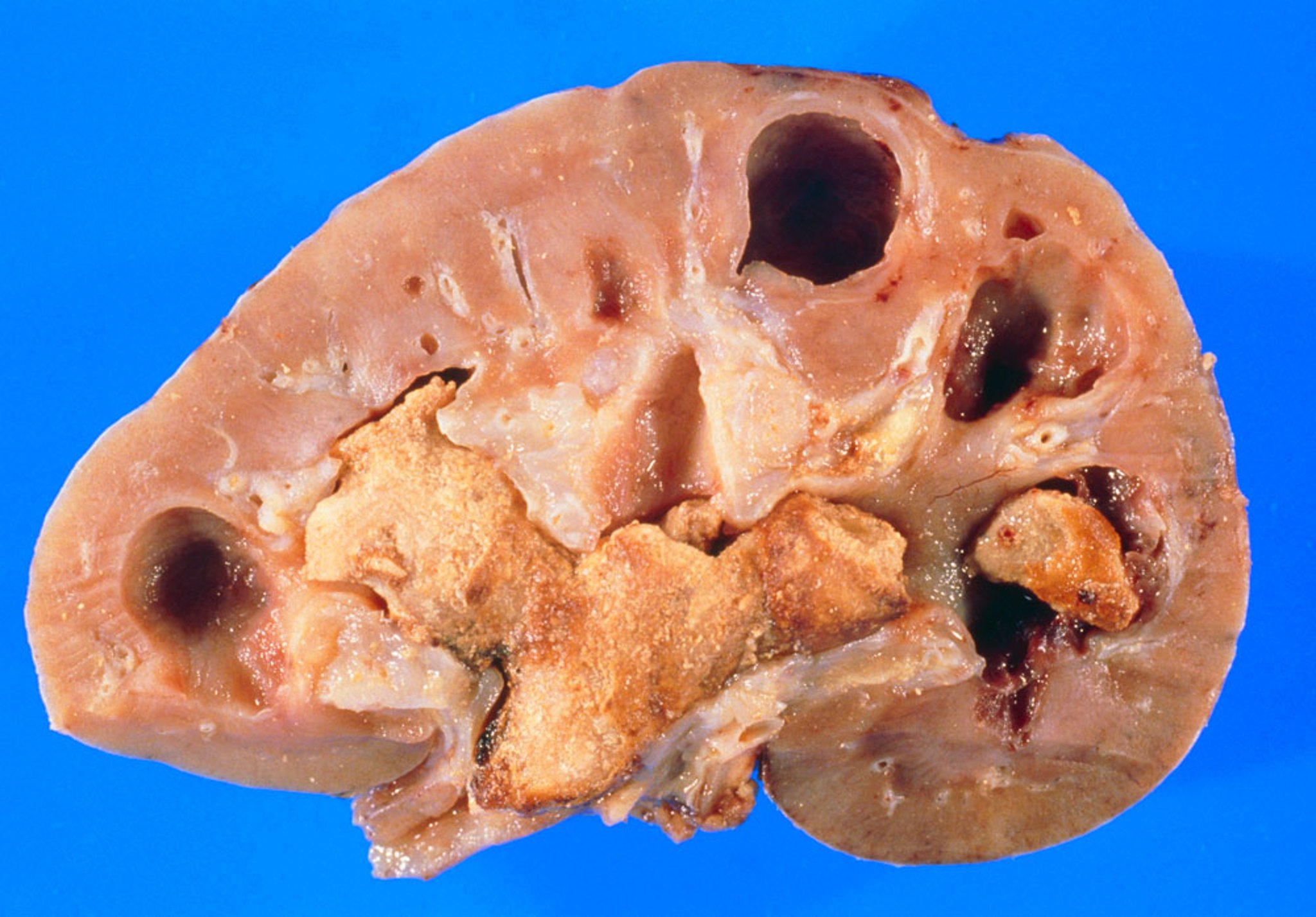 Staghorn Calculus