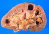 Sỏi Staghorn
