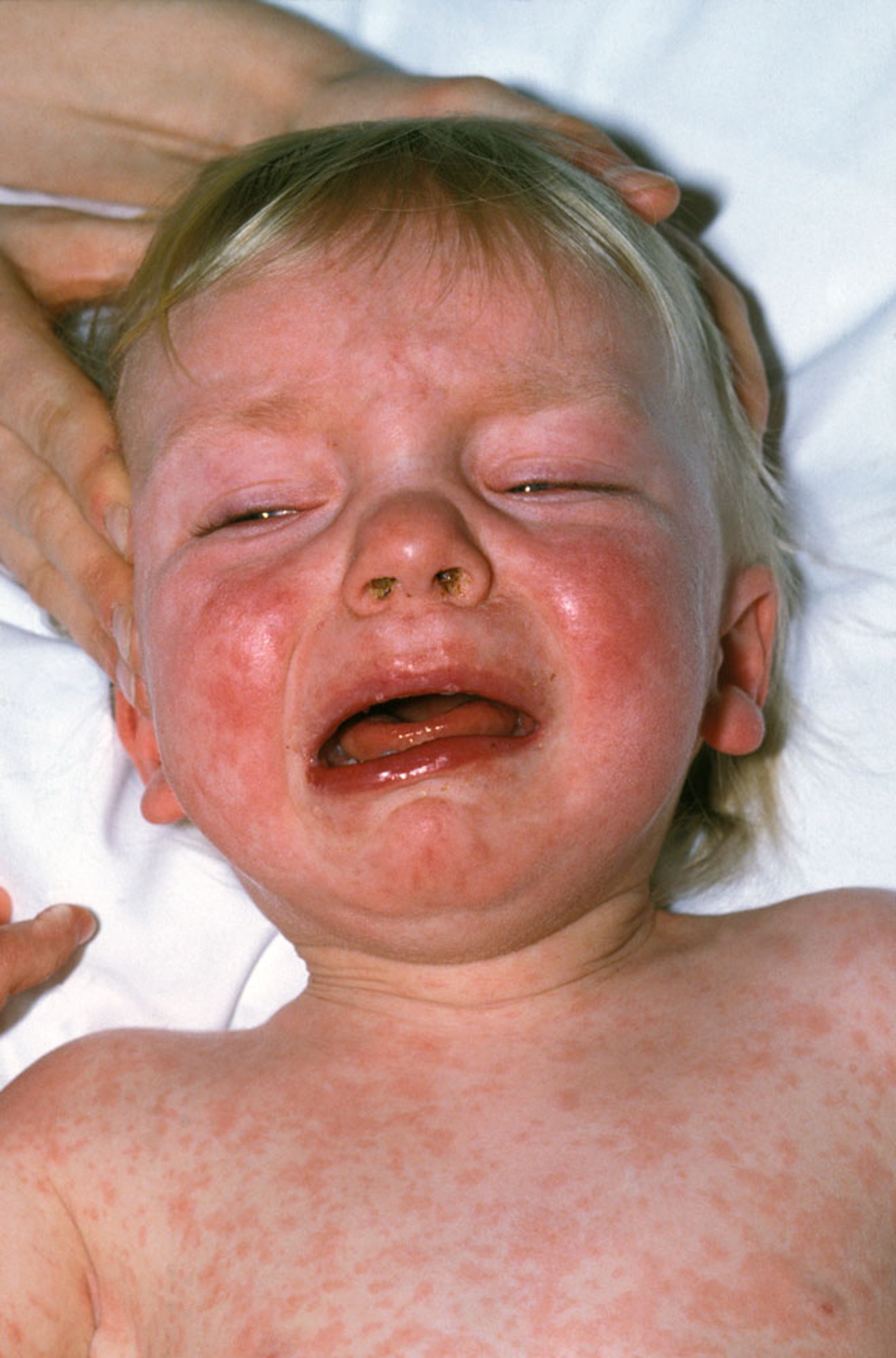 Macular Rash in Measles (2)