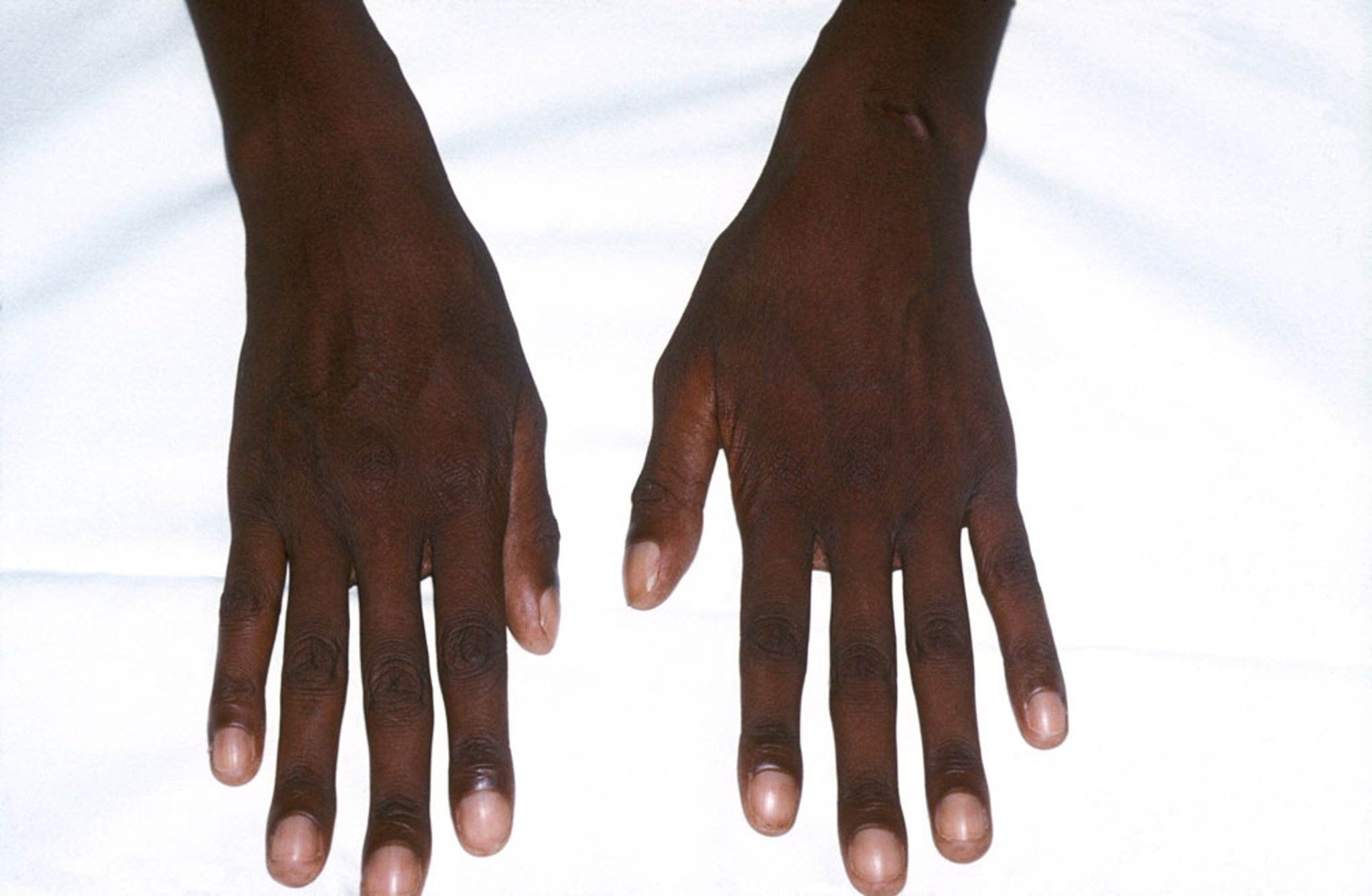 Arachnodactylie dans le syndrome de Marfan (2)