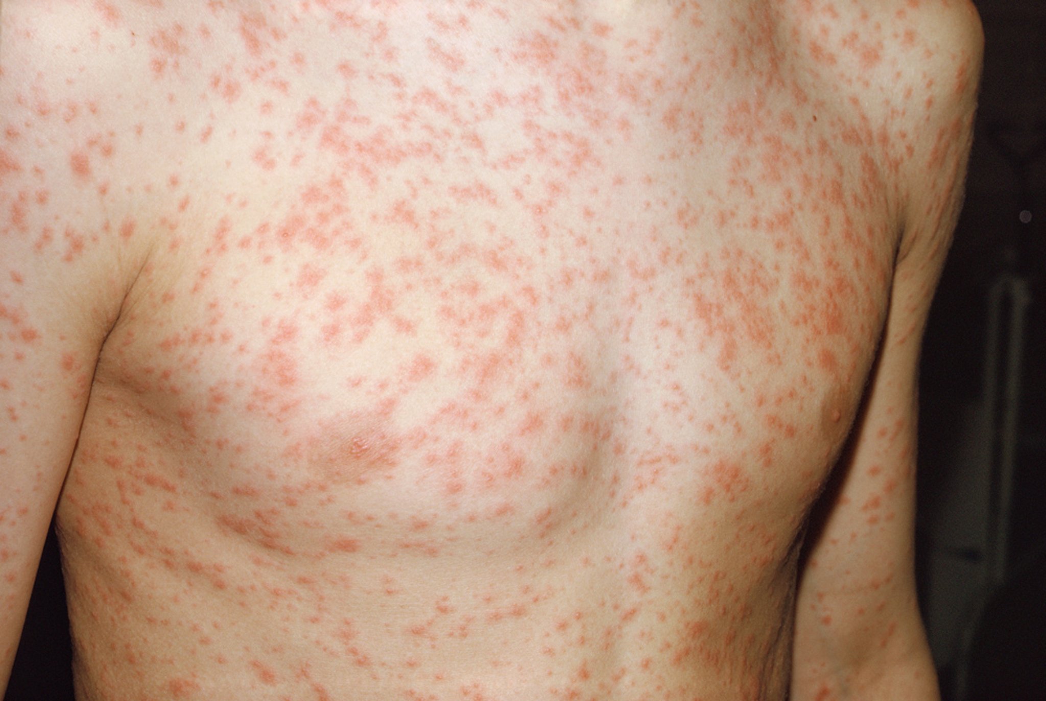 Rubella