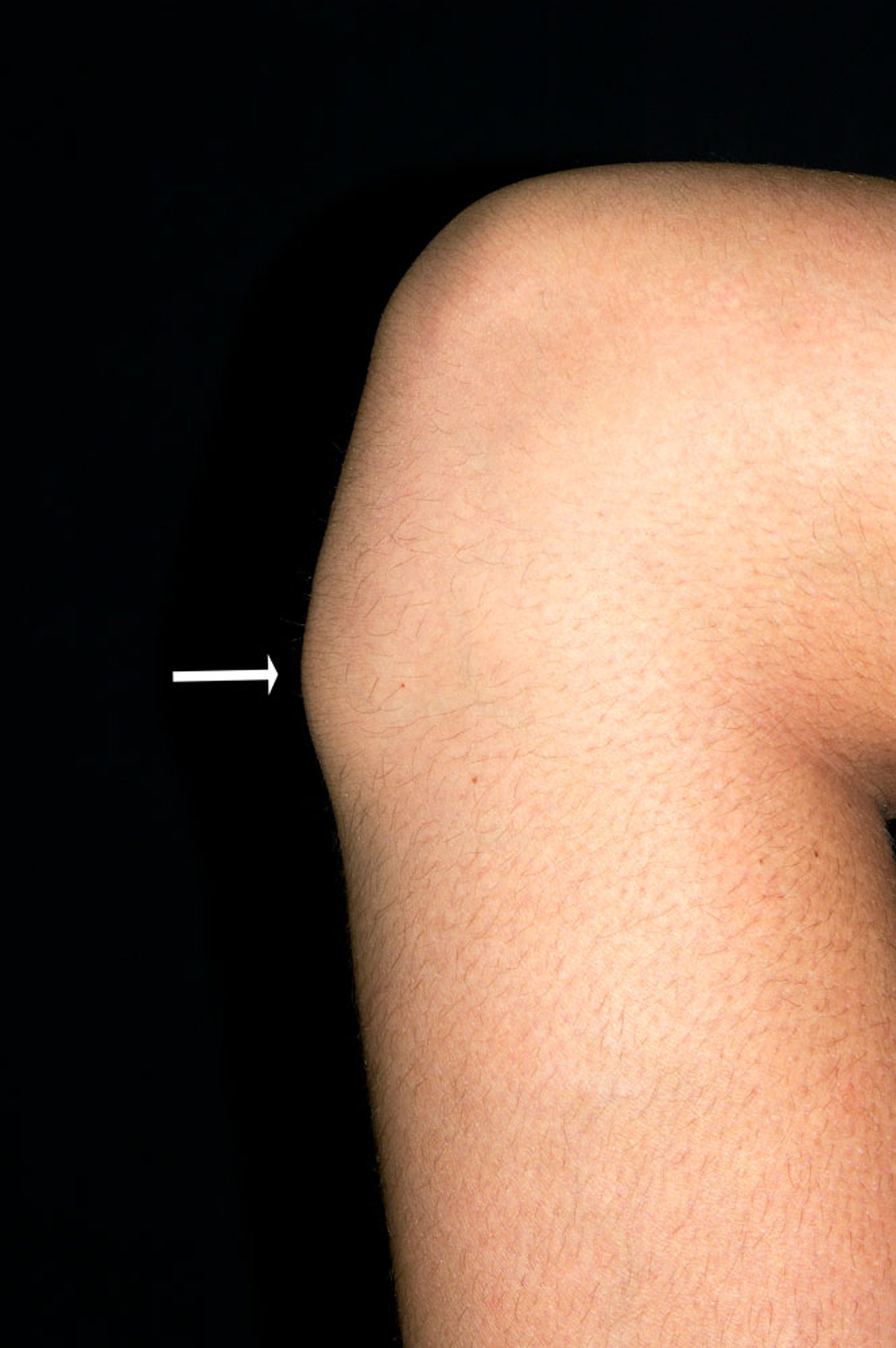 Tibial Tuberosity in Osgood-Schlatter Disease