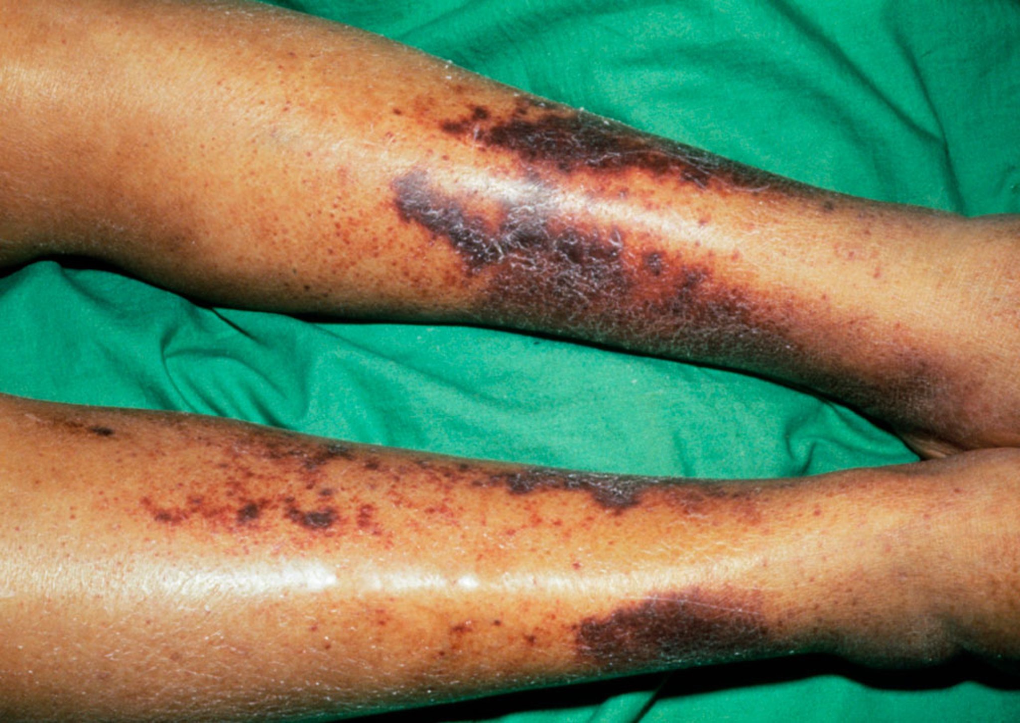 Hemorrhage of the Shins in Scurvy