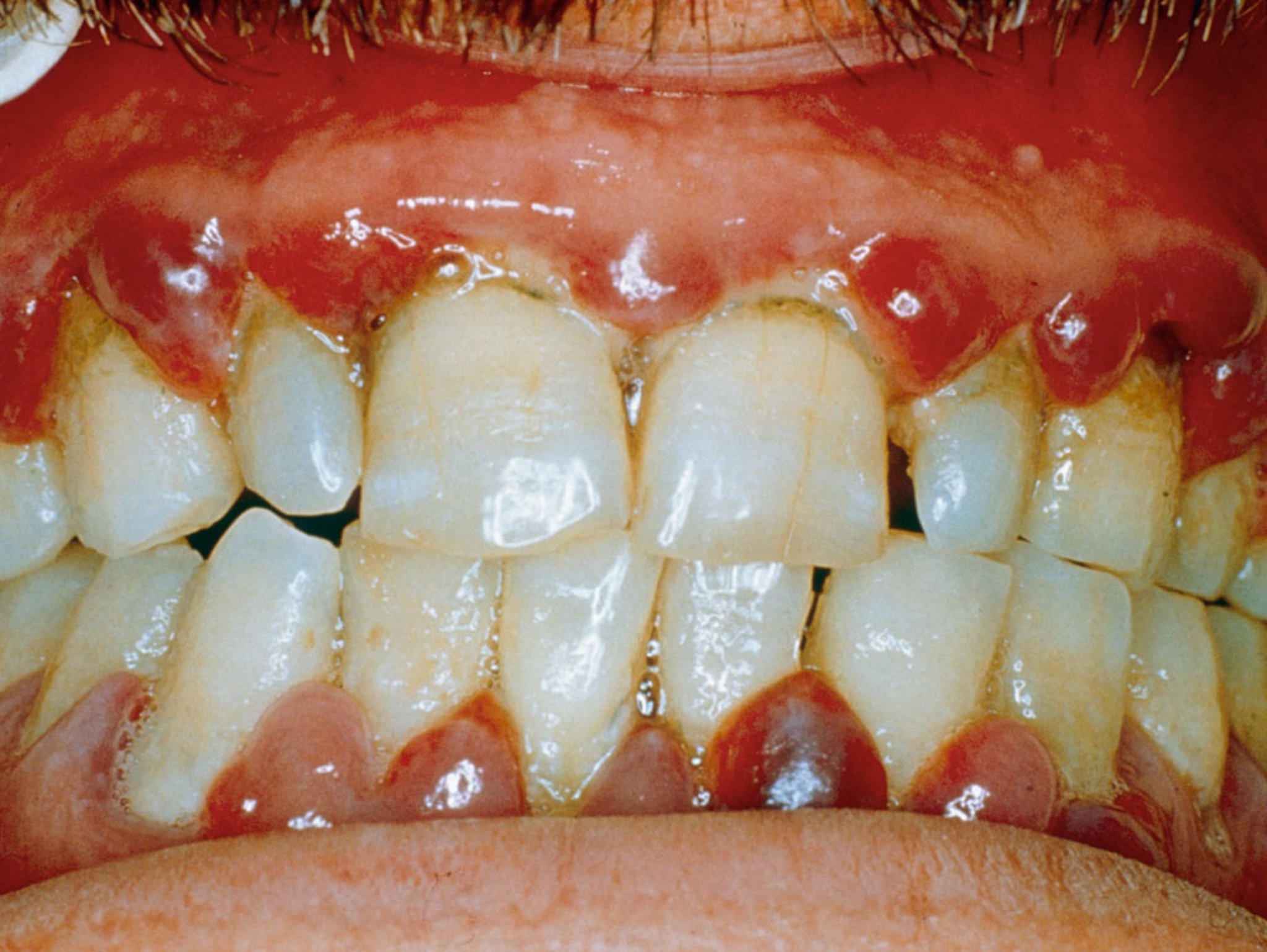 Swollen, Inflamed Gums in Scurvy