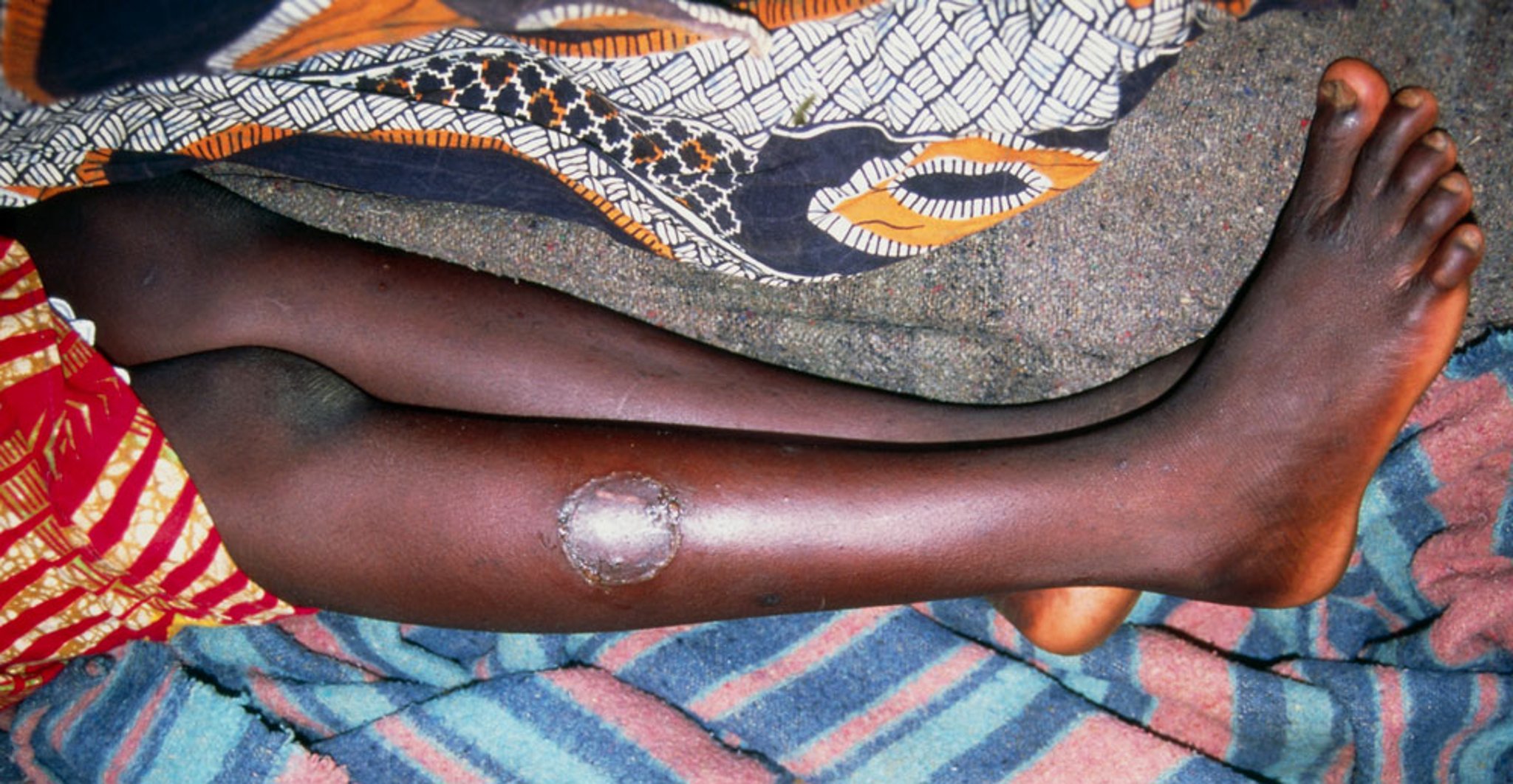 Tripanosomiasis africana (Nódulo)