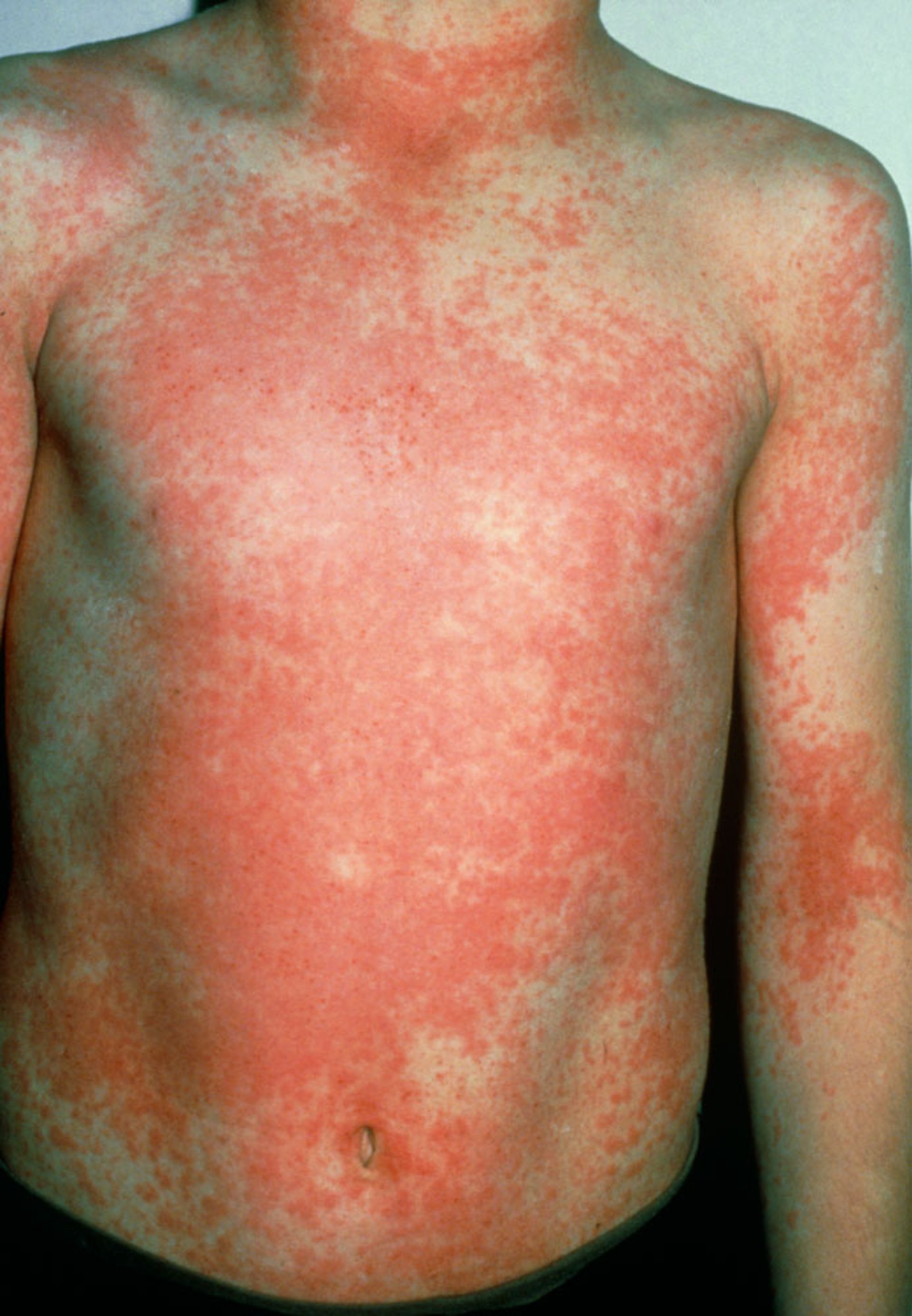 Scarlet Fever (Torso)