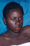 Sindrome di Stevens-Johnson