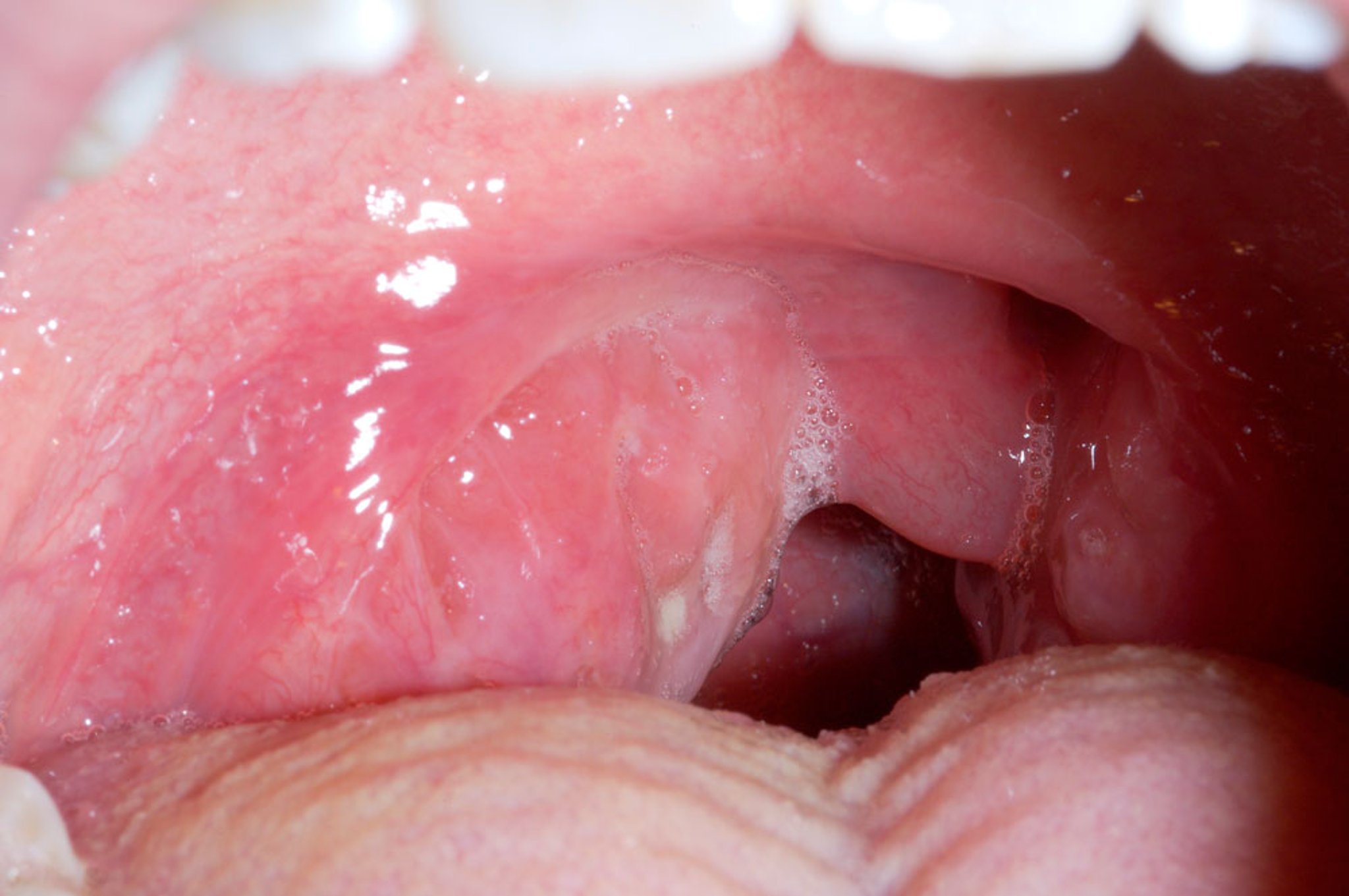 Peritonsillar Abscess With Uvular Deviation