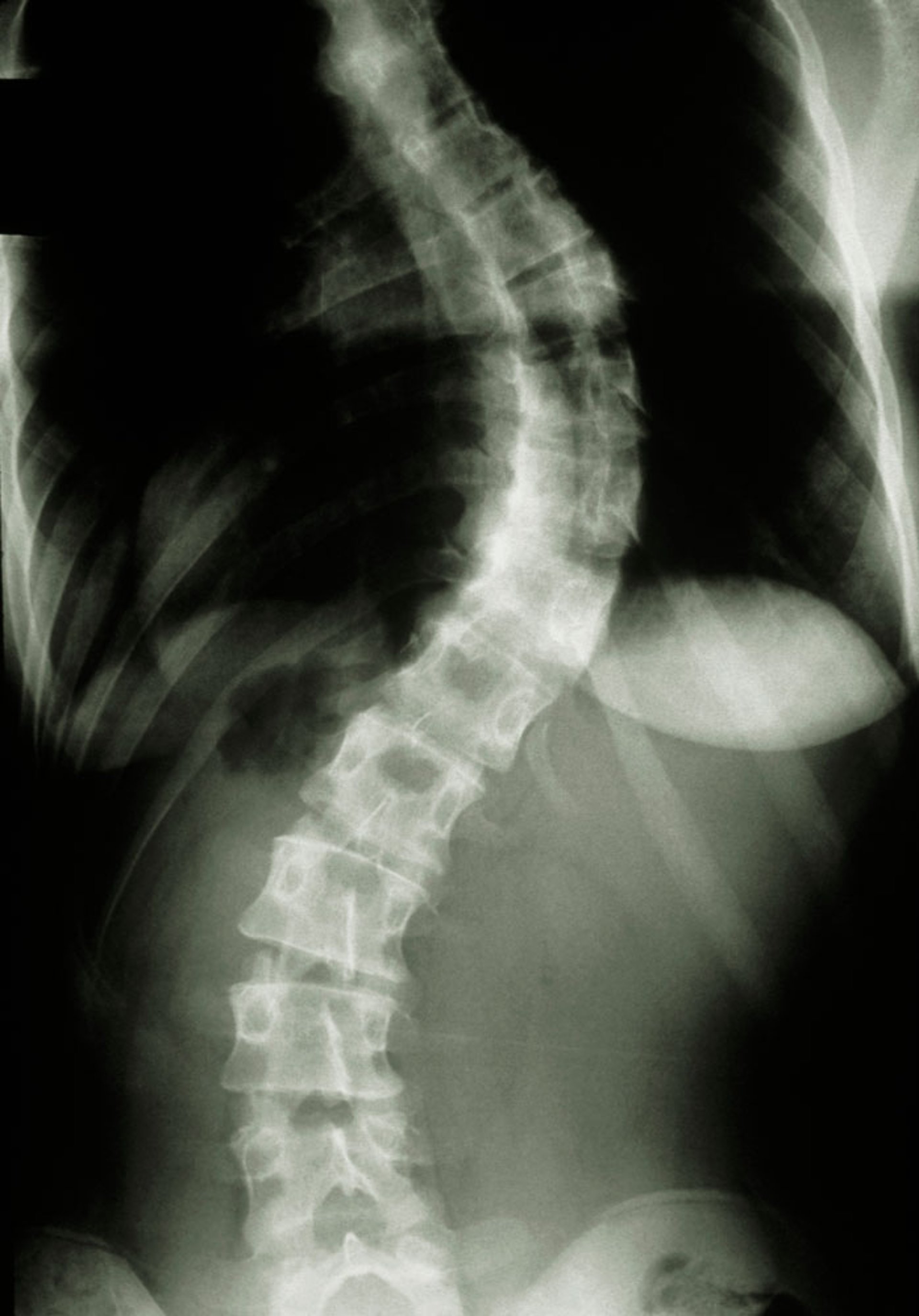Scoliosis (Spinal Radiograph)