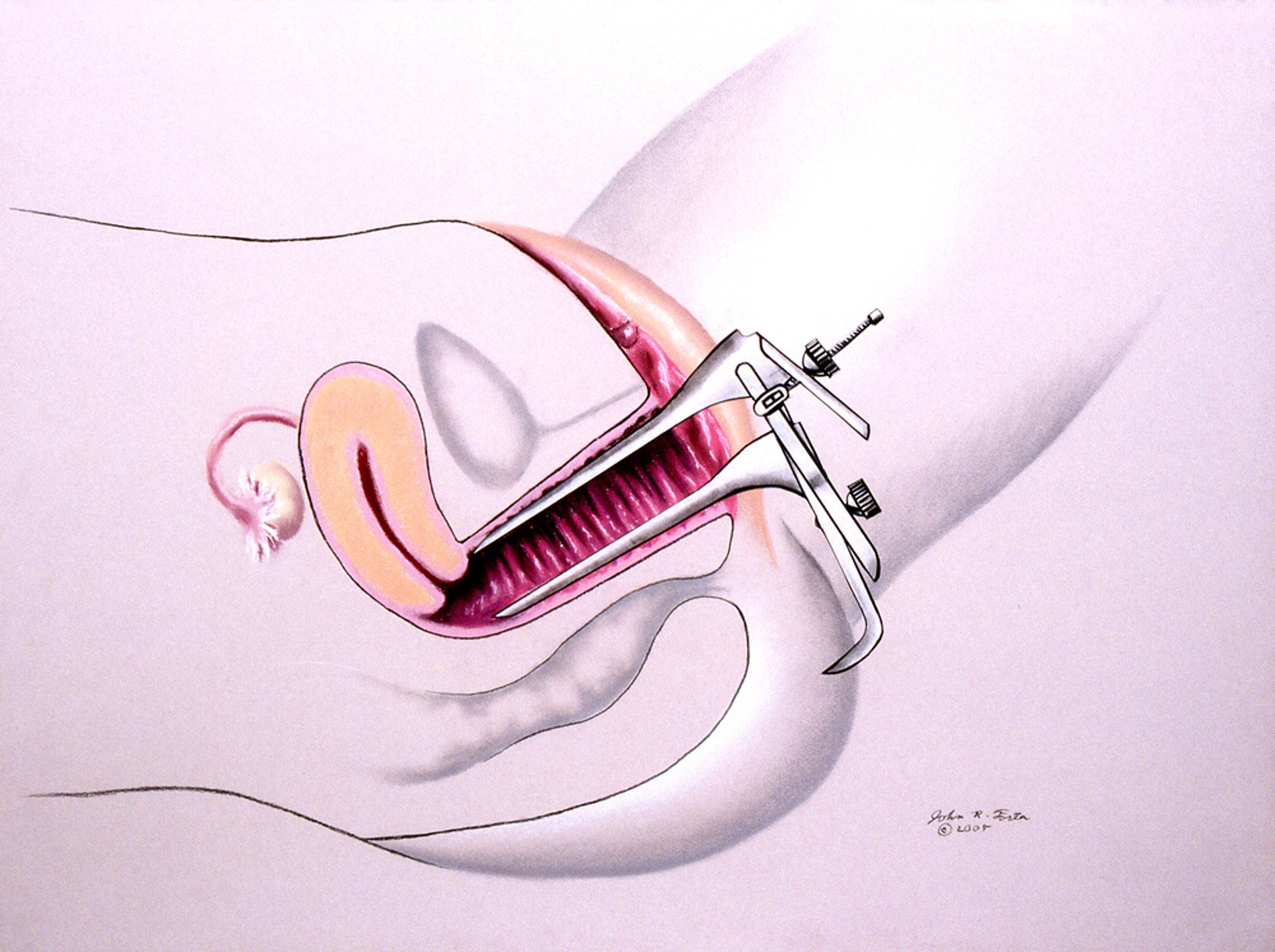 Esame pelvico con speculum