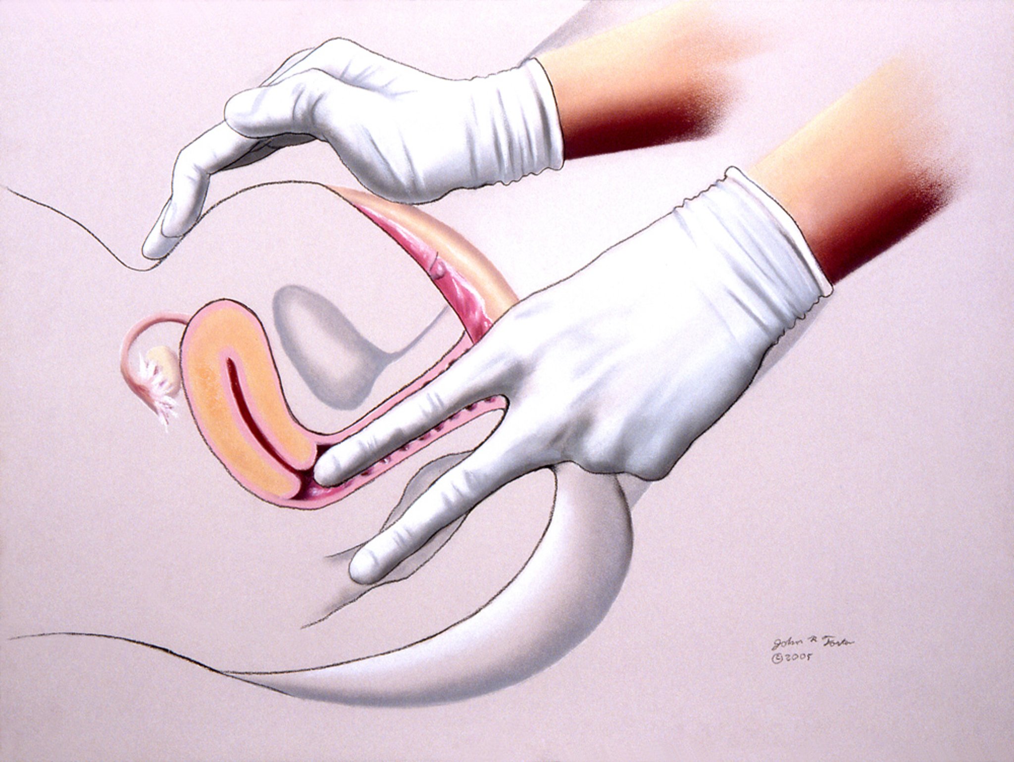 Exame retovaginal pélvico