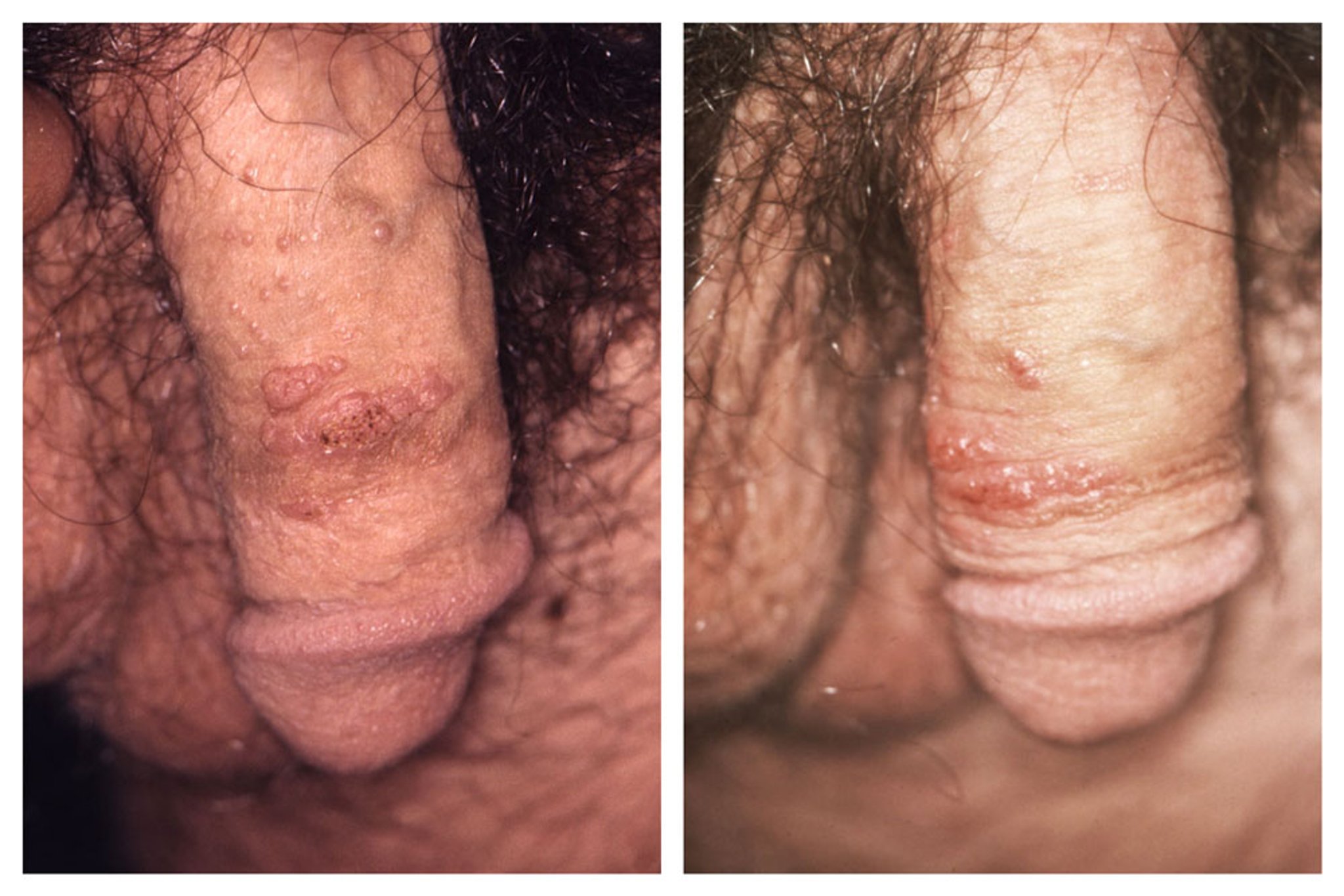 Verrues génitales (homme)